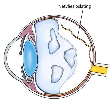 netvliesloslating oogzorg.